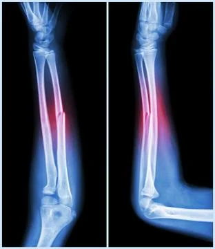 Fracture shaft of ulnar bone ( forearm bone )  :  ( front and side view ) Stock Illustration