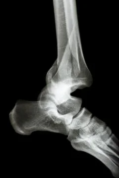 Fracture tibia &amp; fibula (leg's bone) and ankle dislocation Stock Photos