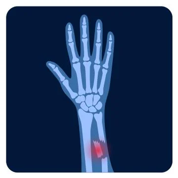 Fracture x ray concept Illustrazione stock