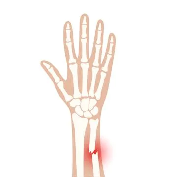 Fracture x ray concept Stock Illustration