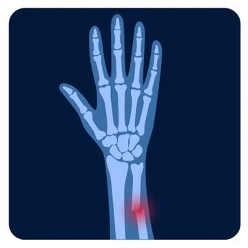 Fracture x ray concept Stock Illustration