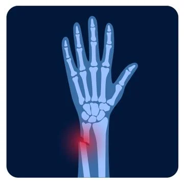 Fracture x ray concept Stock Illustration