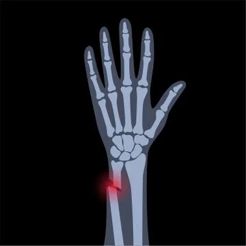 Fracture x ray concept Stock Illustration