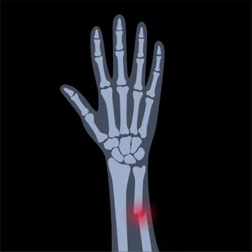 Fracture x ray concept Stock Illustration