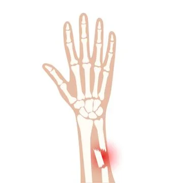 Fracture x ray concept Stock Illustration