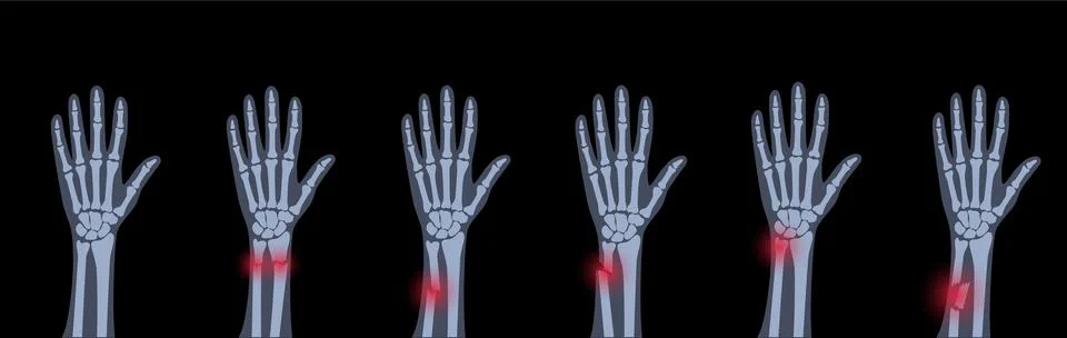 Fracture x ray concept Illustrazione stock