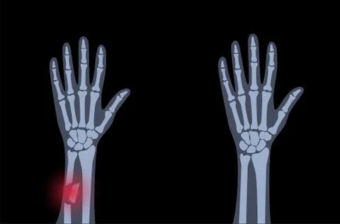 Fracture x ray concept Stock Illustration