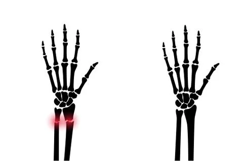 Fracture x ray concept Stock Illustration