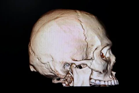 Fracture zygomatic bone Stock Illustration