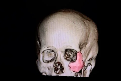 Fracture zygomatic bone Stock Illustration