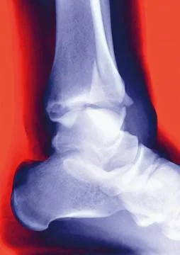 Fractured ankle, x-ray Stock Photos