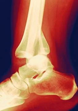 Fractured ankle, x-ray Stock Photos