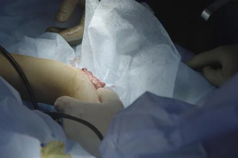 Fractured Bone In a Hand Stockfoto's