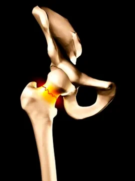 Fractured hip bone, artwork Stock Illustration