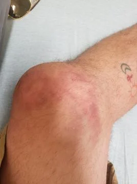 Fractured Knee Foto stock