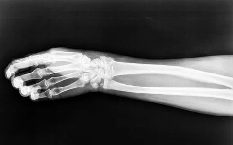 Fractures to the radius born of the right arm on an X-ray Stock Photos