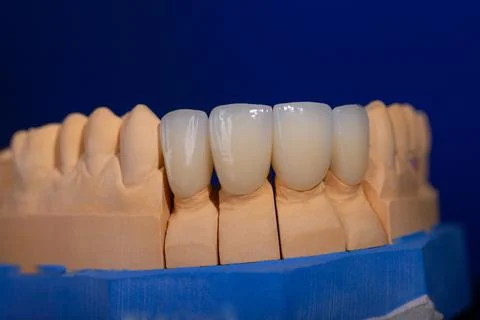 Frames of ceramic crowns on a gypsum model. Zirconia crowns. Metal-free ceramics Stock Photos