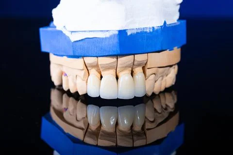 Frames of ceramic crowns on a gypsum model. Zirconia crowns. Metal-free ceramics Stock Photos