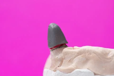 Frames of ceramic-metal  crowns on the stand of the articulator Stock Photos