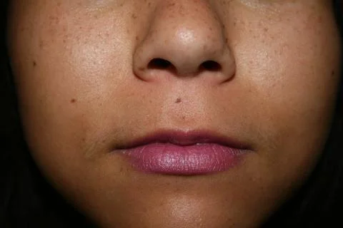 Freckles. Stock Photos