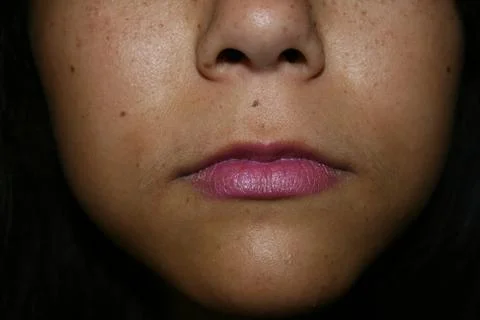 Freckles Stock Photos