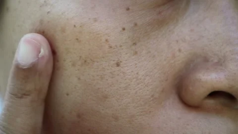 Freckles2 Stock Footage 280374588