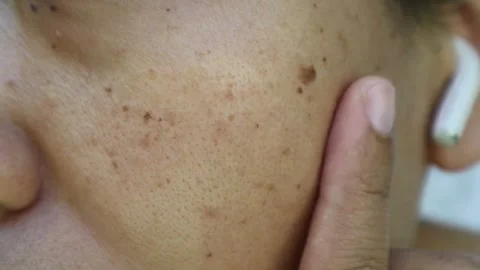 Freckles4 Stock Footage 280374654