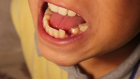 Fresh extraction socket child tooth loss blood dental socket close up 動画素材 332538255