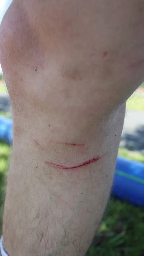 Fresh knee scratch after activity Stock Footage 336487715