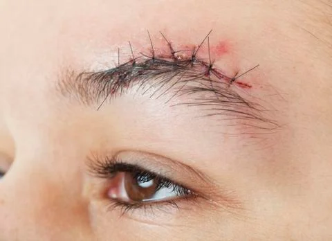 Fresh stitches Stock Photos