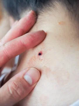Fresh wound Foto stock