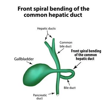 Front spiral bending of the common hepatic duct. Pathology of the gallbladder Stock Illustration