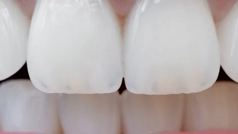 Front teeth close up. Perfect white female front teeth close up Stock Footage 140579739