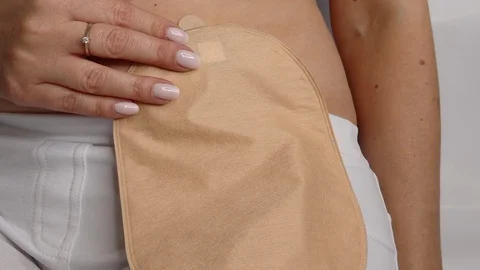 Front view on colostomy bag attached to woman patient, medical theme.  Stock Footage 122275036