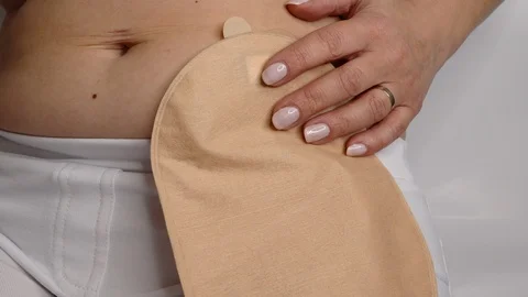 Front view on colostomy bag attached to woman patient, medical theme.  Video stock 122275085