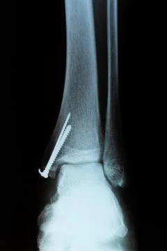 Front view of X-RAY scan. Human leg with metal screw after the surgery. Stock Photos
