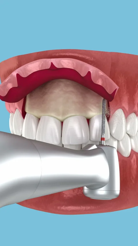 Frontal gum line correction, surgery, Esthetic surgery. Dental 3D animation 库存影片 314537985