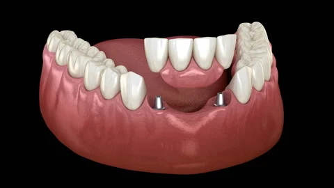 Frontal teeth bridge supported by implants. Medically accurate 3D animation Stock Footage 119422001