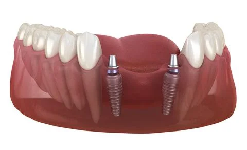 Frontal teeth bridge supported by implants. Medically accurate 3D animation Stock Illustration