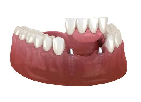 Frontal teeth bridge supported by implants. Medically accurate Stock Illustration