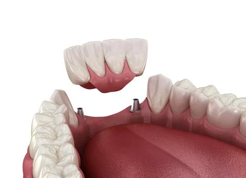 Frontal teeth bridge supported by implants. Medically accurate Stock Illustration