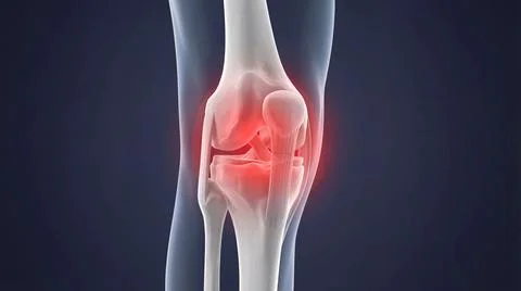 Frontal view of human knee joint anatomy highlighting ligament and bone damag Illustrazione stock