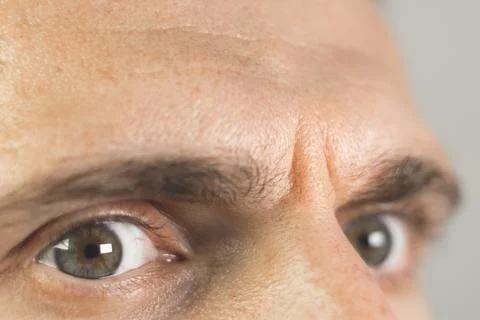 Frown lines between eyebrows on mans face. Vertical wrinkles, close up. Stock Photos