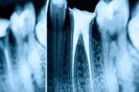 Full Obturation of Root Canal Systems Stock Photos