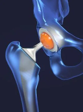Function of a hip joint implant or hip prosthesis in frontal view Stock Illustration