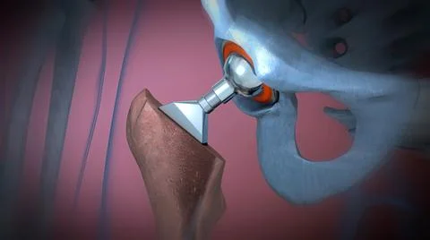 Function of a hip joint implant or hip prosthesis in frontal view Stock Illustration