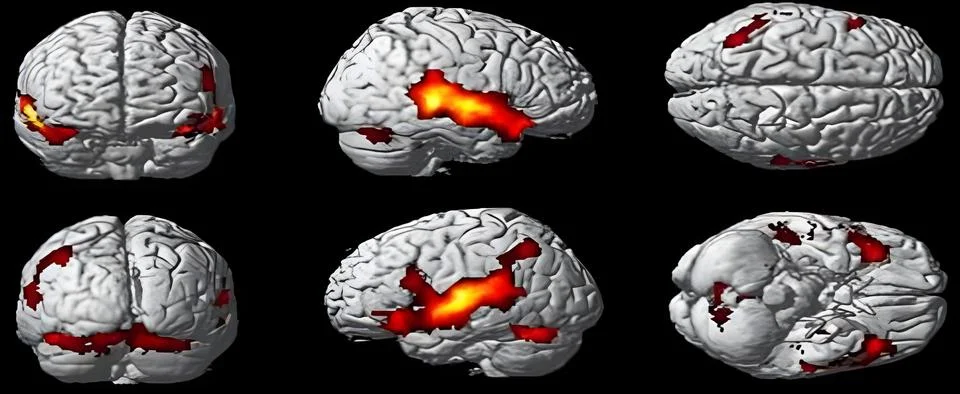 Functional Brain Mapping Highlighting Neural Activity with Advanced Imaging.. Stock-Fotos