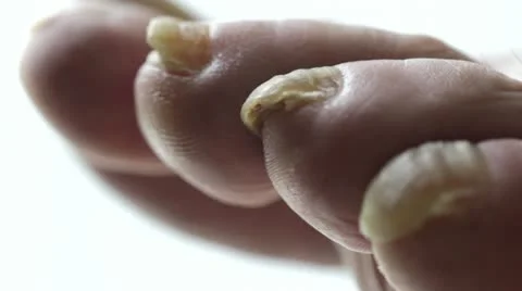 Fungal Nail Stock Footage 22779114