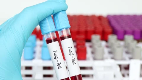 Fungi test, blood sample to analyze in the laboratory Stock Footage 239508072