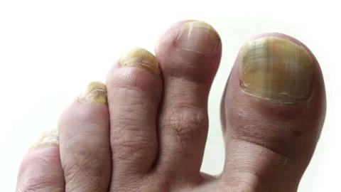 Fungi Toes Stock Footage 22779121